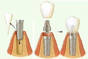 odnomoment implant 300x203 - Методы и виды имплантации
