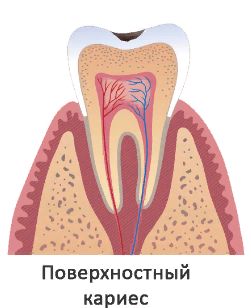 9oa84PG - Лечение кариеса