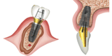 superline img02 - Имплантат Dentium Superline